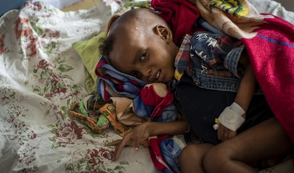 A two-year-old Tigrayan child is treated for malnutrition at the Ayder Referral Hospital in Mekele, in the Tigray region of northern Ethiopia, May 6, 2021 (AP)