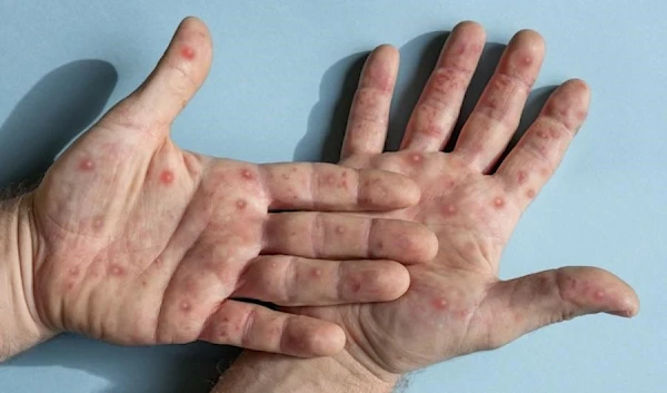 Monkeypox retreating but threat remains, experts warn