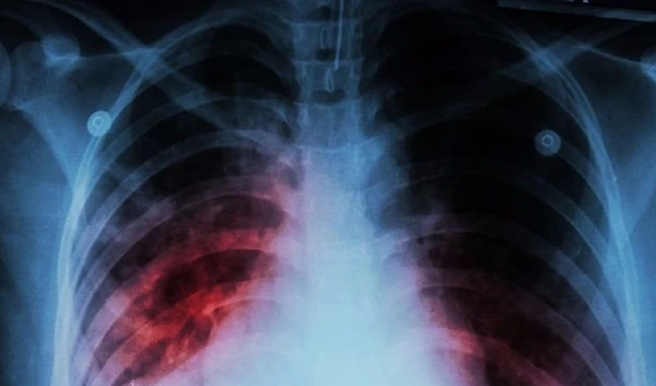 Tuberculosis (also known as TB) is one of the deadliest infectious diseases in the world.