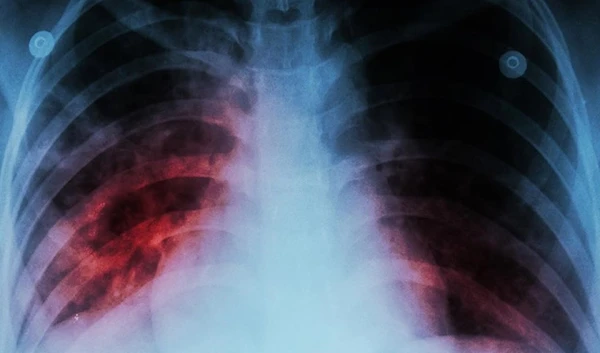 Tuberculosis on the rise after years of decline