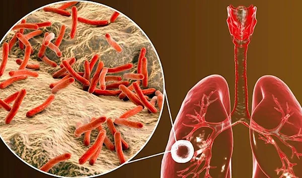 Tuberculosis cases rise for 1st time in years