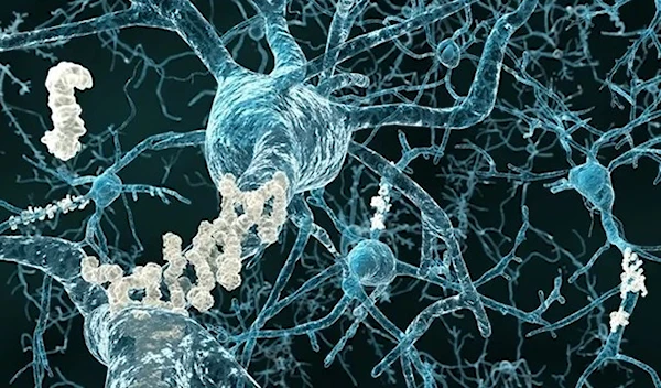 Alzheimer's disease - neurons with amyloid plaques. (Photo: Juan Gaertner / Shutterstock)