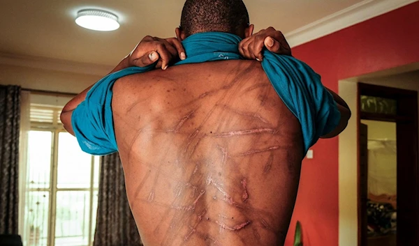 Ugandan writer Kakwenza Rukirabashaija displays scars on his back he claims were inflicted by torture, Feb. 8, 2022 (AP)