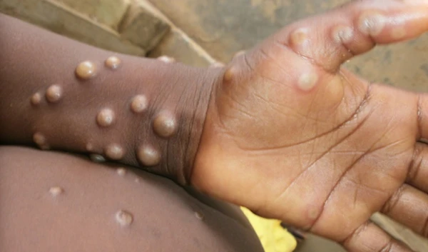 Cases of monkeypox are often found close to tropical rainforests (WHO)