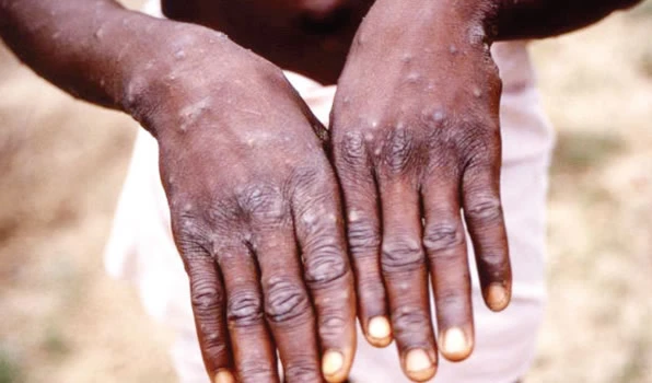 Nigera had confirmed 21 of 66 suspected cases of the disease.