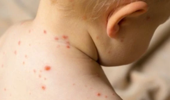 Monkeypox has been detected in US among children