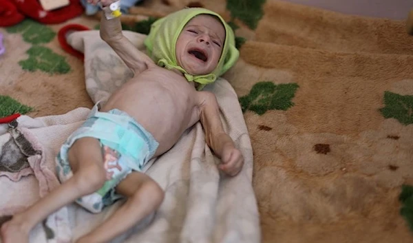 A malnourished boy cries as he lies on a hospital bed in Sanaa (Archive)