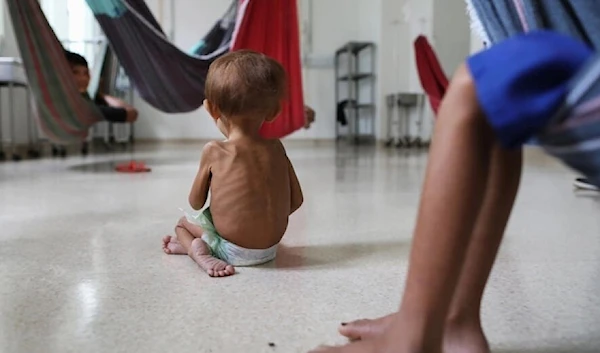 At a hospital in the Brazilian Amazon, Yanomami children are being treated for malnutrition and other ailments. (AFP)