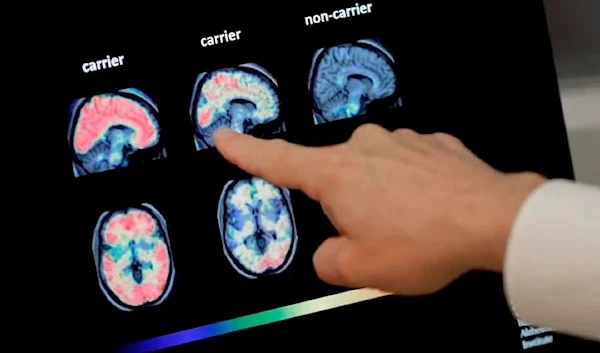 A doctor looks at PET brain scans. (AP)