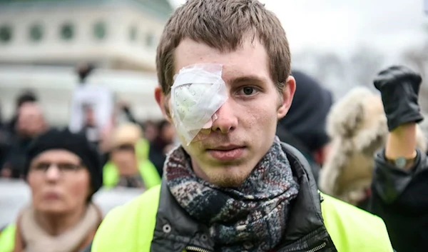 Franck Didron was blinded in the right eye by a rubber bullet fired at him by French police during a yellow vest protest in 2019. (AFP)