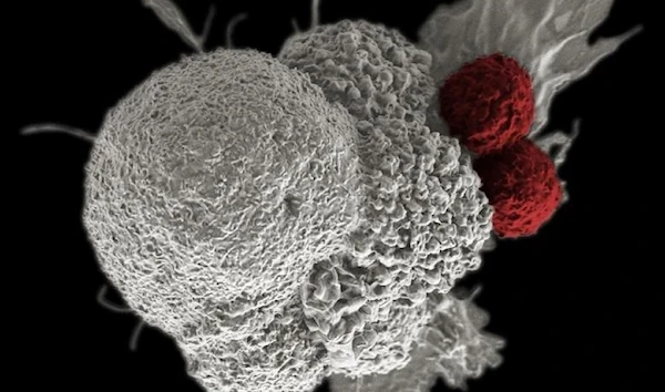 White Cancer cell gets identified and attacked by two cytotoxic T cells, as part of the body's natural immune response to cancer. (Reuters)