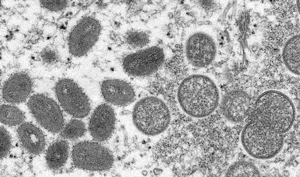 Pakistan reports 1st case of Monkeypox virus