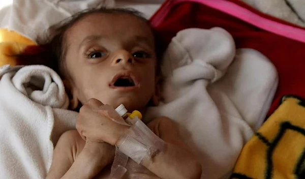 A Yemeni child suffering from acute malnutrition due to the Saudi-led war on Yemen. (Reuters)