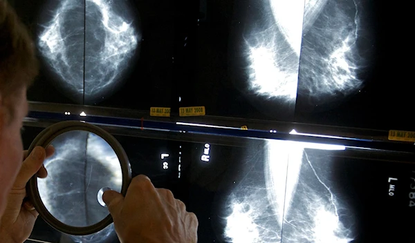 A radiologist uses a magnifying glass to check mammograms for breast cancer in Los Angeles, May 6, 2010 (AP Photo/Damian Dovarganes, File)