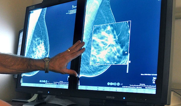 A 2022 picture representing how the NHS had started cancer treatment for about 7,000 more people every month compared to 10 years ago. (AP)