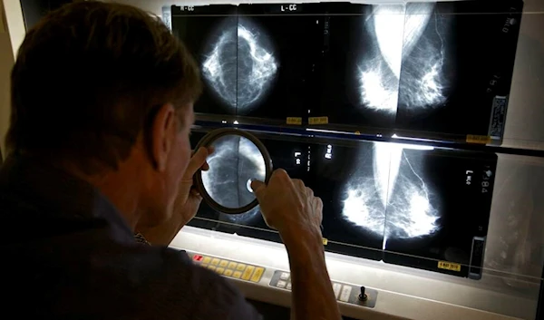 Medical Director Radiologist, Dr. Gerald Iba, checks mammograms, an advanced imaging screening that promotes early detection of breast cancer. (Damian Dovarganes/AP)