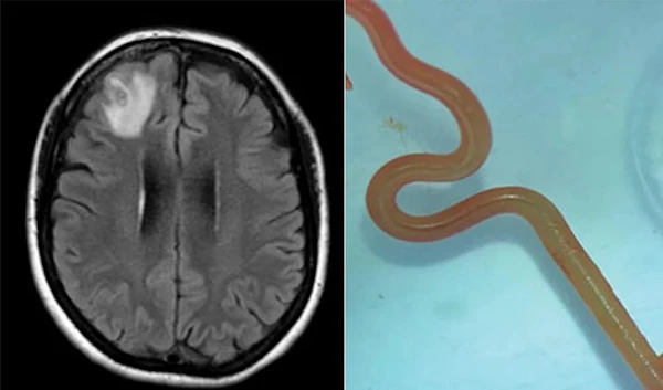 A photo showing the patient's brain scan and a photo of the roundworm (CDC.gov)