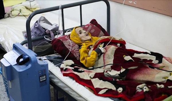 Late Palestinian child Yazan Kafarneh on his hospital bed in Rafah before being starved to death due the Israeli genocidal and starvation war, southern Gaza. (AP)