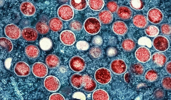 This colorized electron microscope image provided by the National Institute of Allergy and Infectious Diseases shows mpox particles, red, found within an infected cell. (AP)