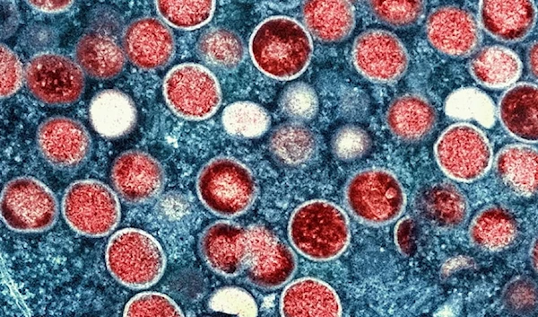 The colorized electron microscope image provided by the National Institute of Allergy and Infections Diseases shows Mpox particles, red, found within an infected cell. (AP)