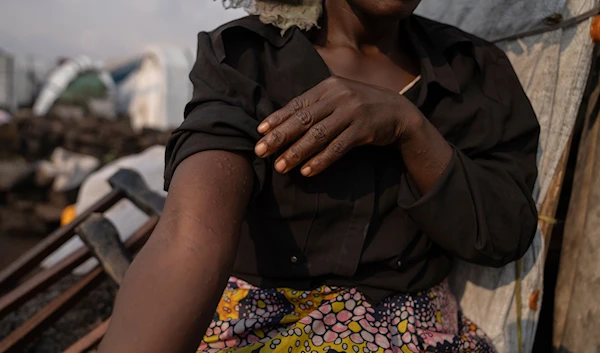 Sarah Bagheni, in the Bulengo refugee camp in Goma, Congo, suspects she may be infected with Mpox after the World Health Organization had declared Thursday, Aug, 15, 2024 (AP)