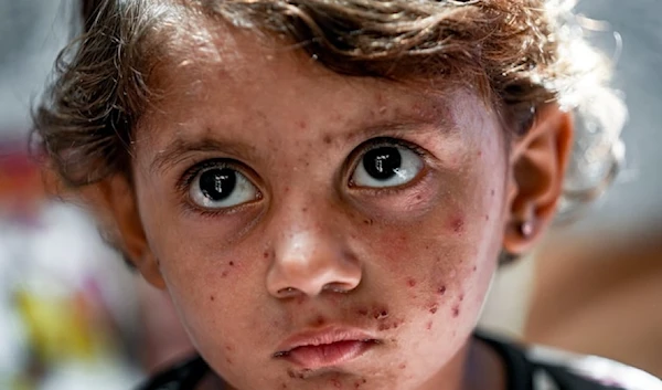 Forcibly displaced Palestinian child Toleen Marshoud, who suffers from skin disease, sits at a makeshift tent camp in Deir al-Balah, central Gaza Strip, Monday July 29,2024. (AP)