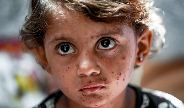 Displaced child Toleen Marshoud, who suffers from skin disease, sits at a makeshift tent camp in Deir al-Balah, central Gaza Strip, Monday, July 29, 2024. (AP)